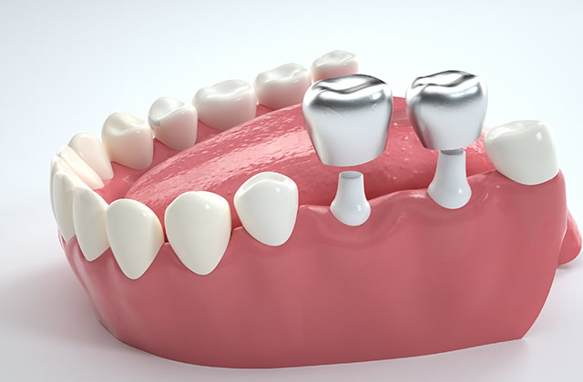种植牙材料有几种？种牙的材料该怎么选择