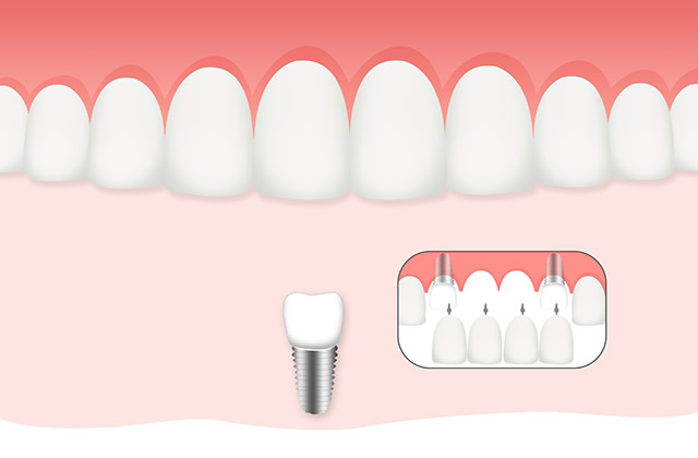 种植牙是什么意思 种植牙多少钱一颗